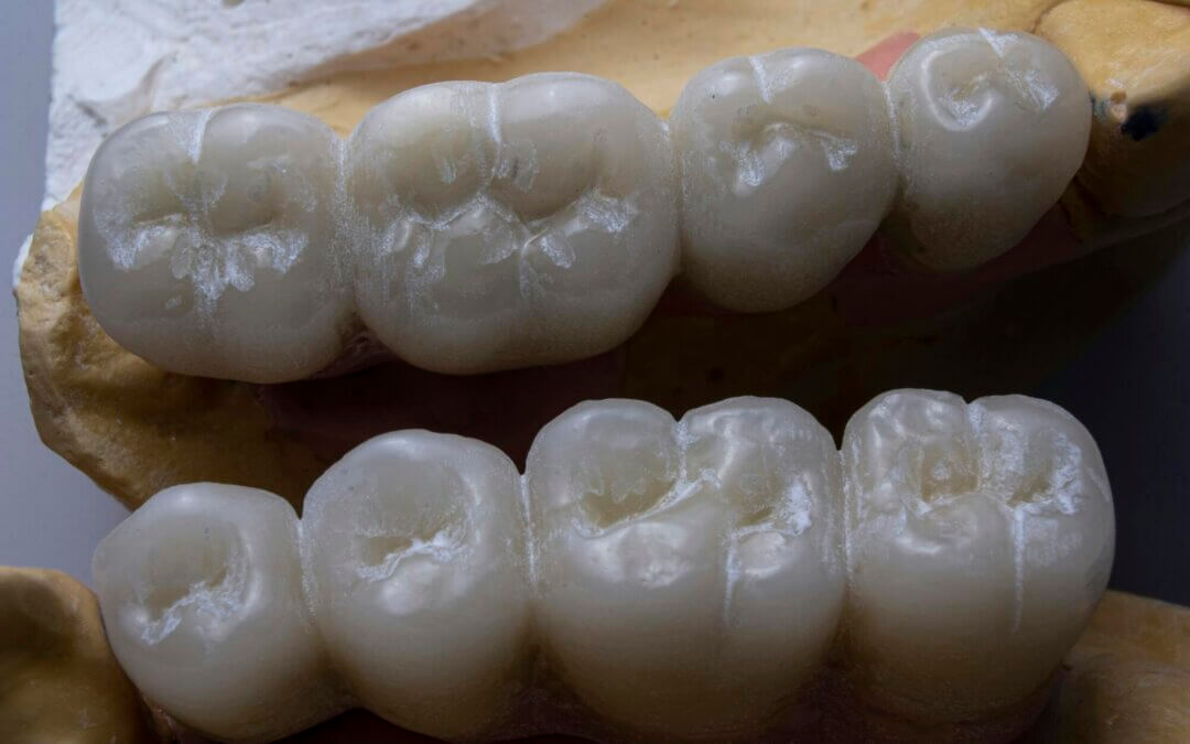 what causes cavities