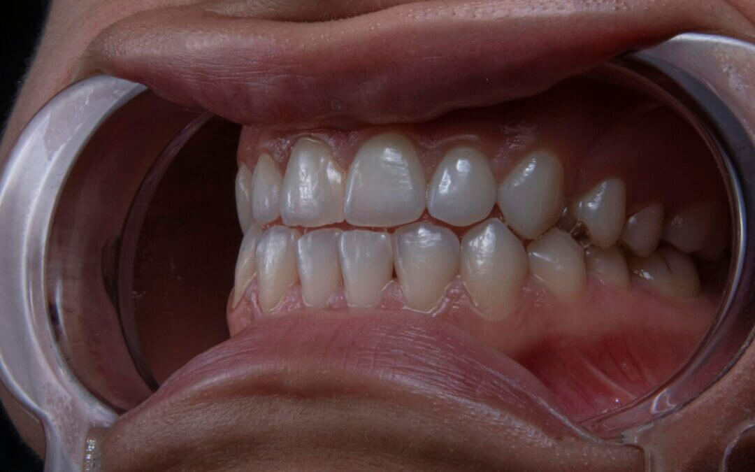are cavities normal