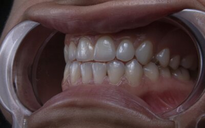 Are Cavities Normal in Kids? A Guide for Elizabethtown Parents